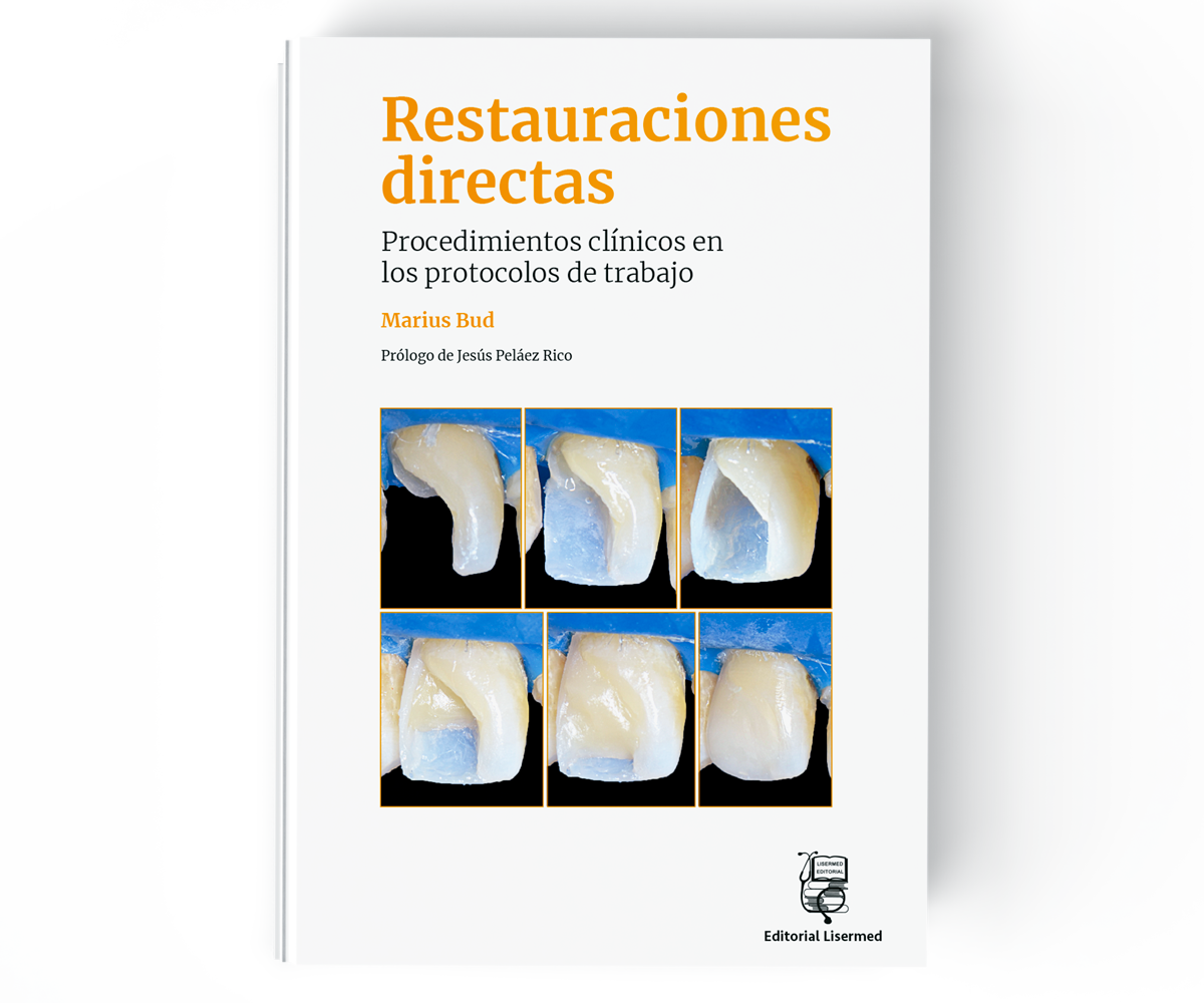 restauraciones-directas-marius-bud